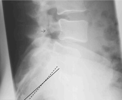 sacrum x-ray